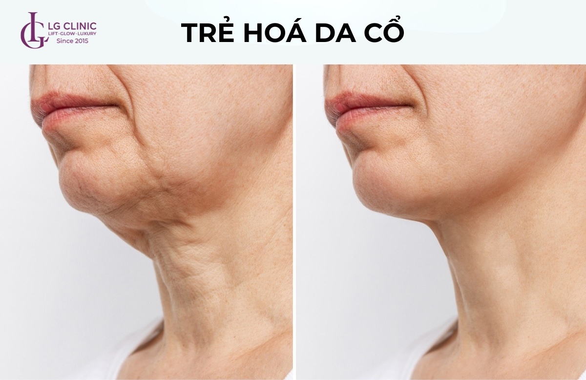 Lý do da vùng cổ nhanh lão hoá