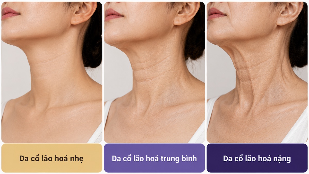 Các mức độ lão hoá da vùng cổ