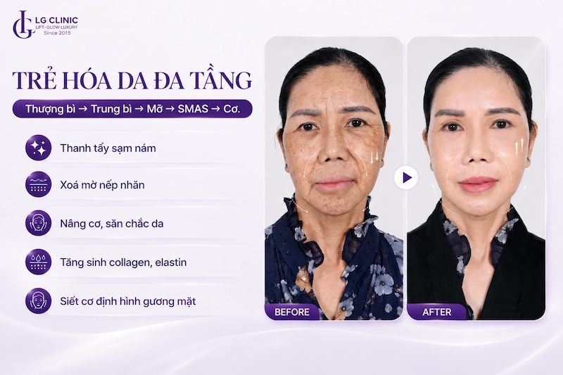 trẻ hoá da đa tầng