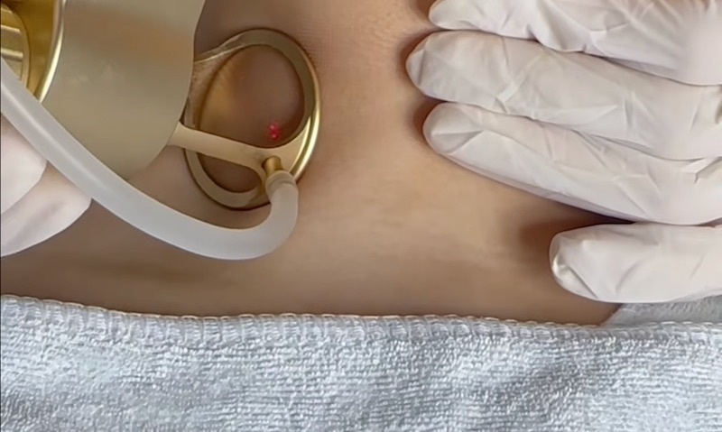 trẻ hoá da cổ bằng laser