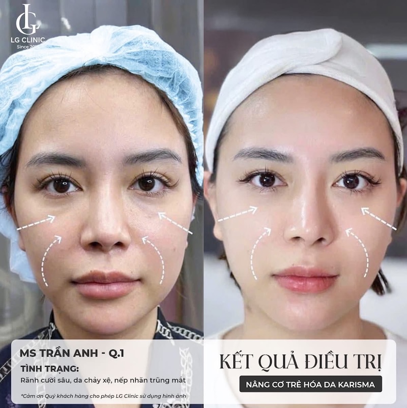 trẻ hoá vùng mắt