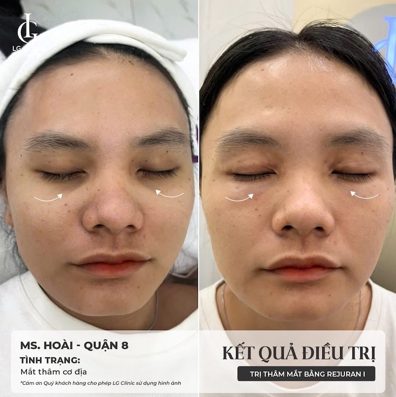 trẻ hoá vùng mắt