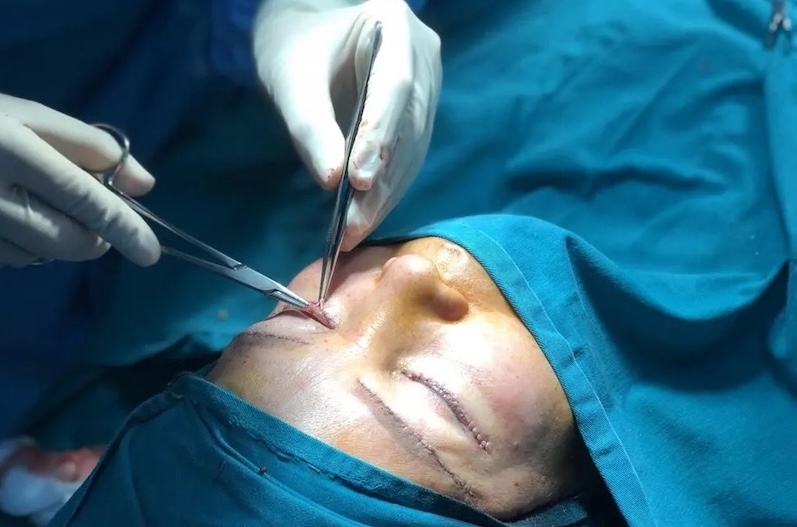 phẫu thuật trẻ hoá vùng mắt