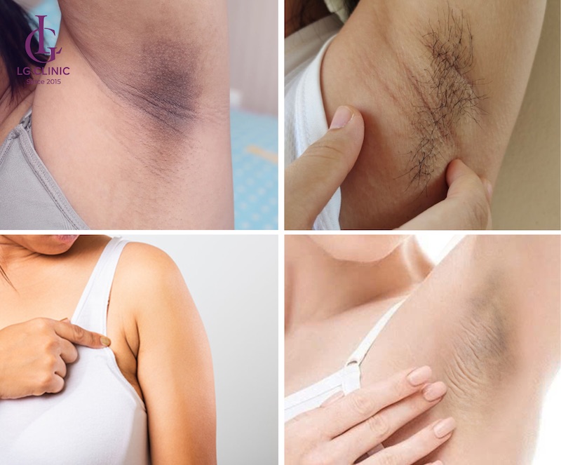 nguyên nhân nách bị lão hoá