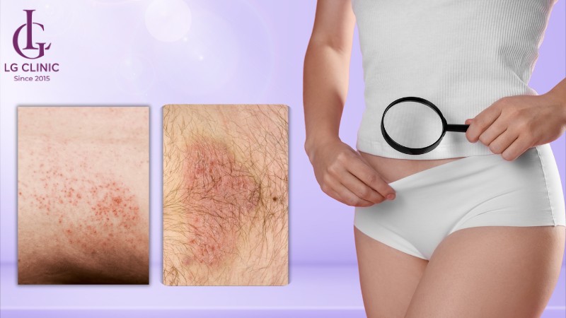 nguyên nhân gây viêm da vùng kín