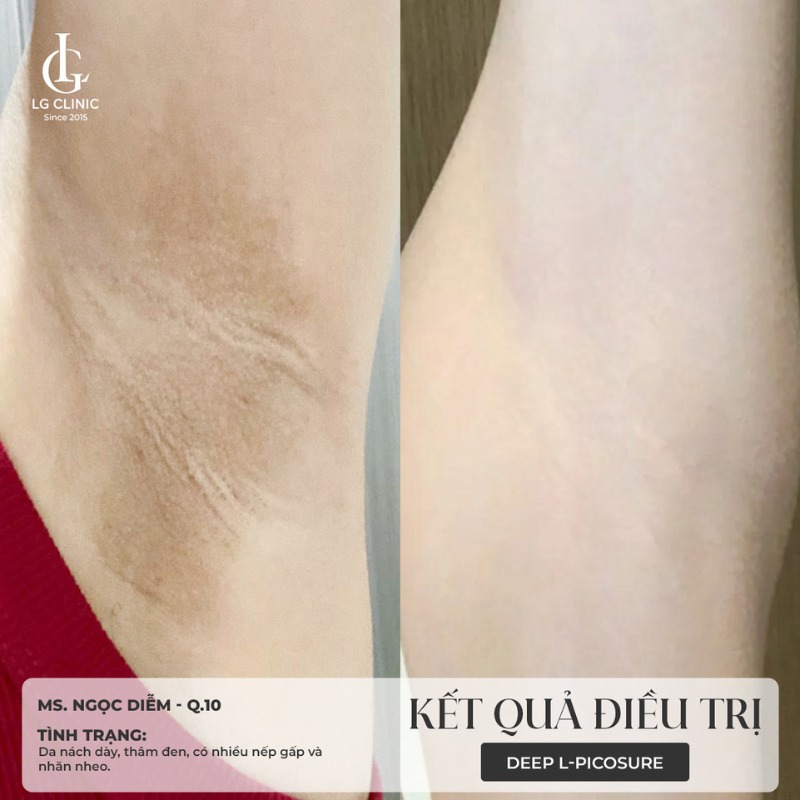 trị thâm nách bằng laser