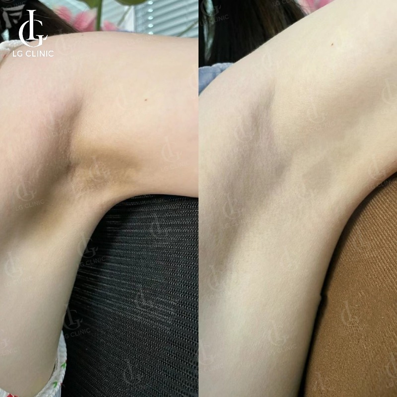 trị thâm nách bằng laser