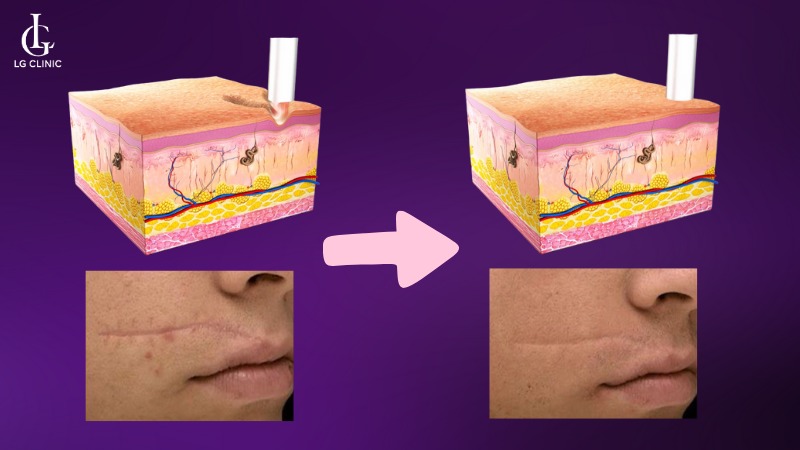laser fotona trị sẹo lõm