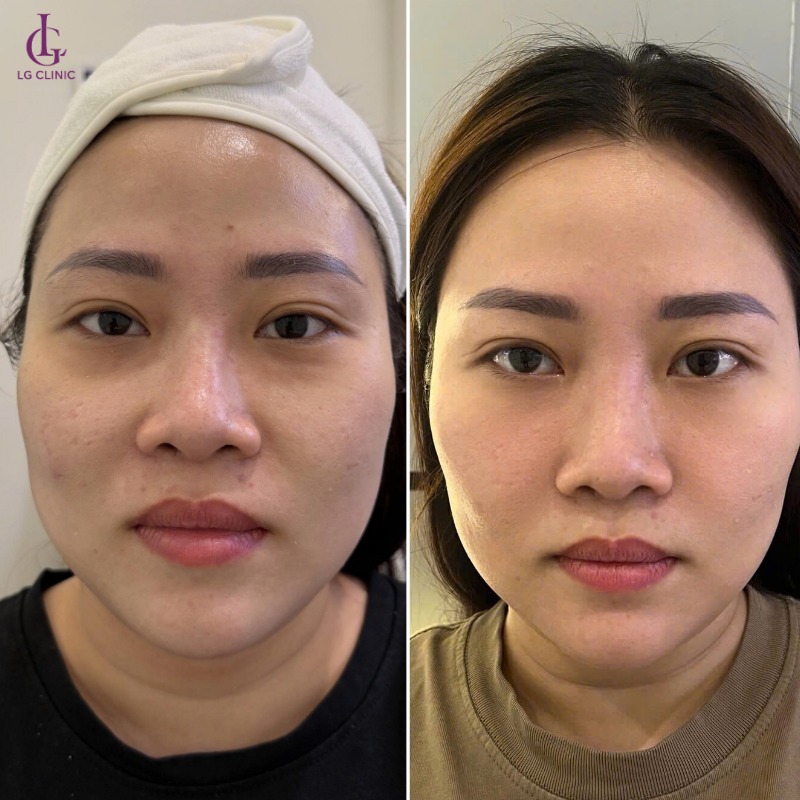 bắn discovery trị thâm