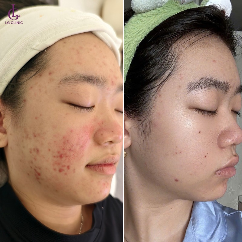 bắn discovery trị thâm