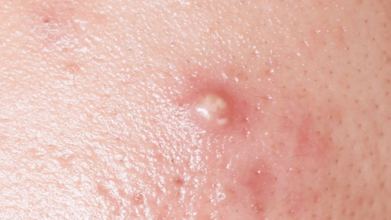 mụn trứng cá mọc ở vùng kín