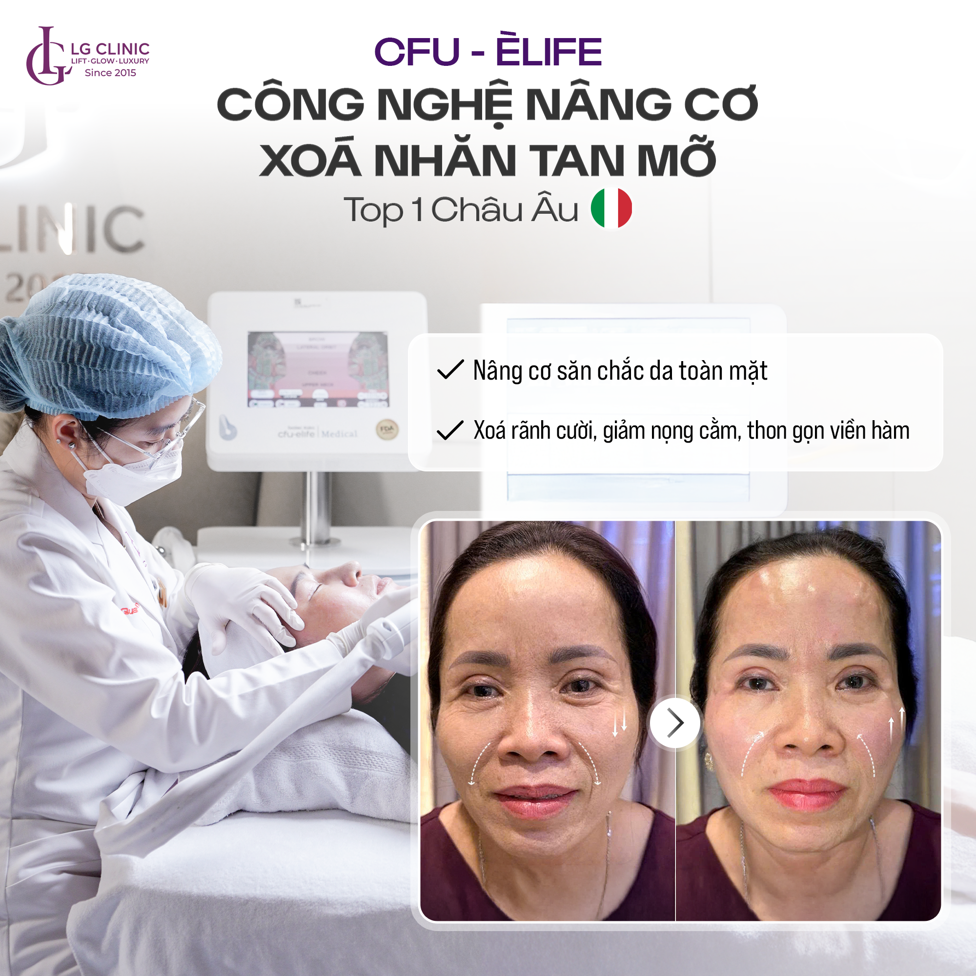 Công nghệ CFU Èlife tại LG Clinic