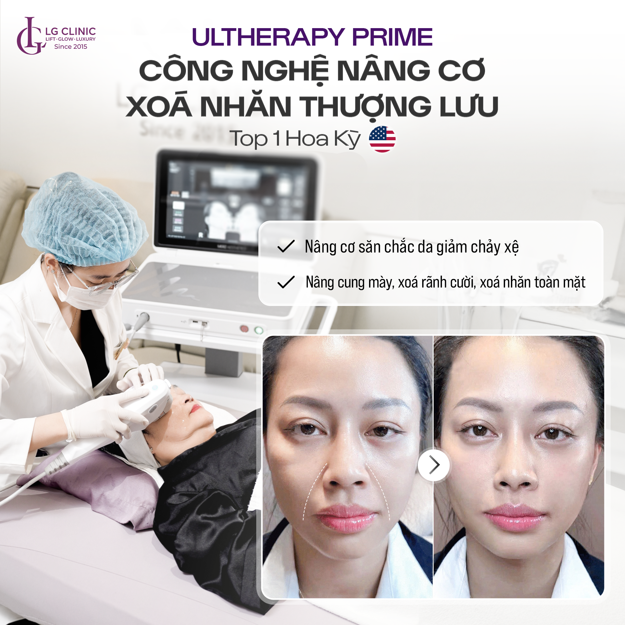 Công nghệ nâng cơ Ultherapy Prime tại LG Clinic