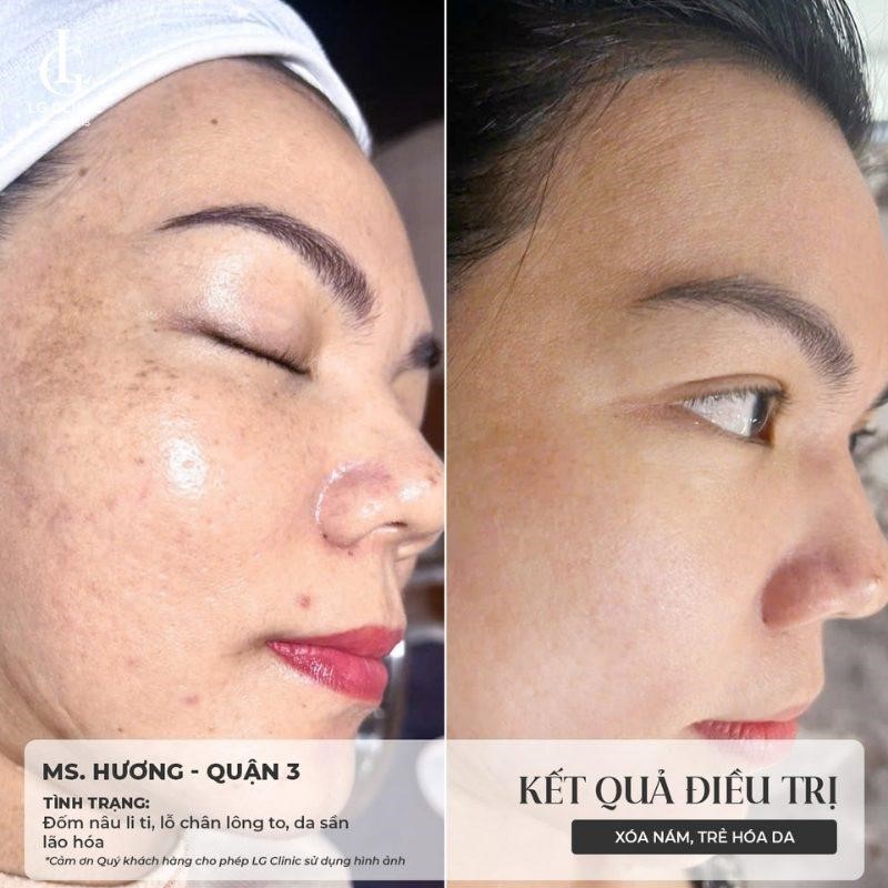 Discovery Pico là gì