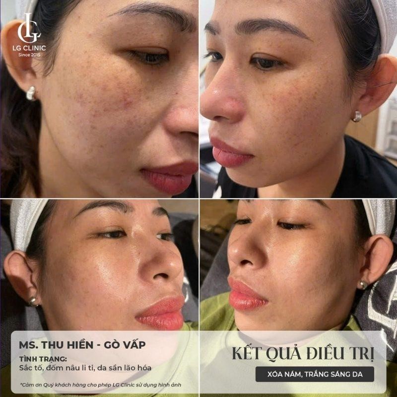 Discovery Pico là gì