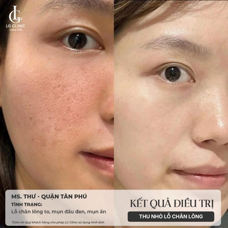 Discovery Pico là gì