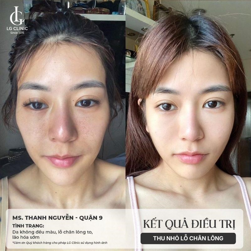 Discovery Pico là gì