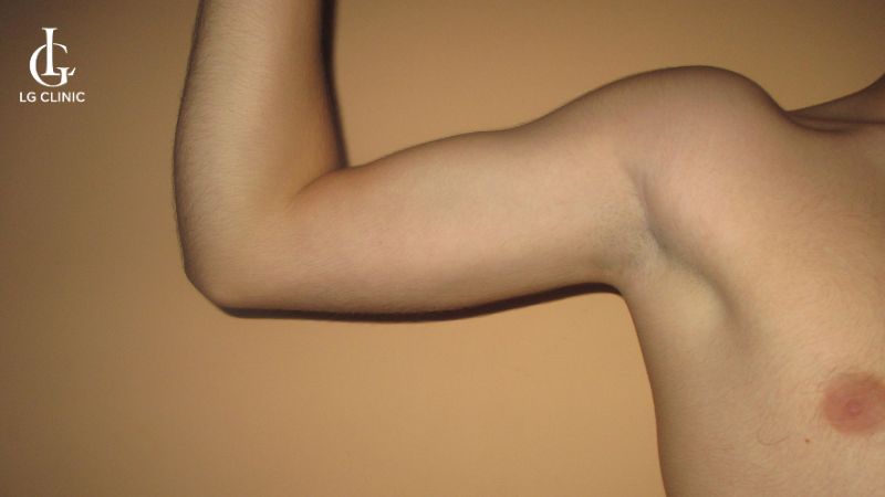 không mọc lông nách có sao không