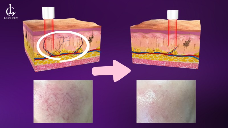 laser fotona điều trị mạch máu