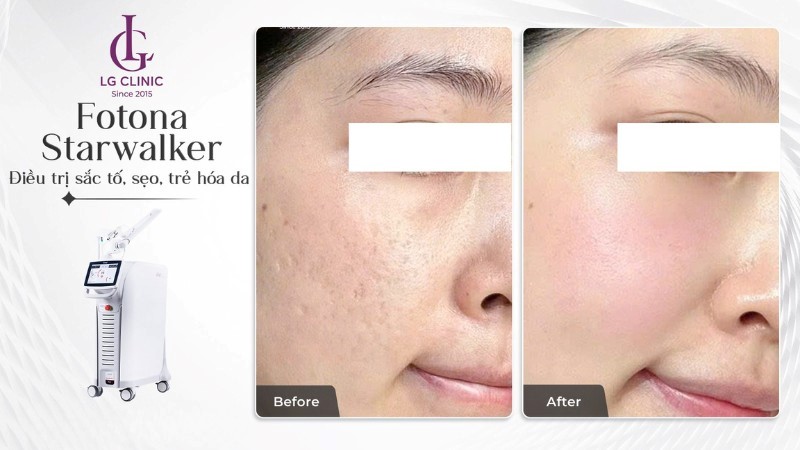 laser fotona trị sẹo
