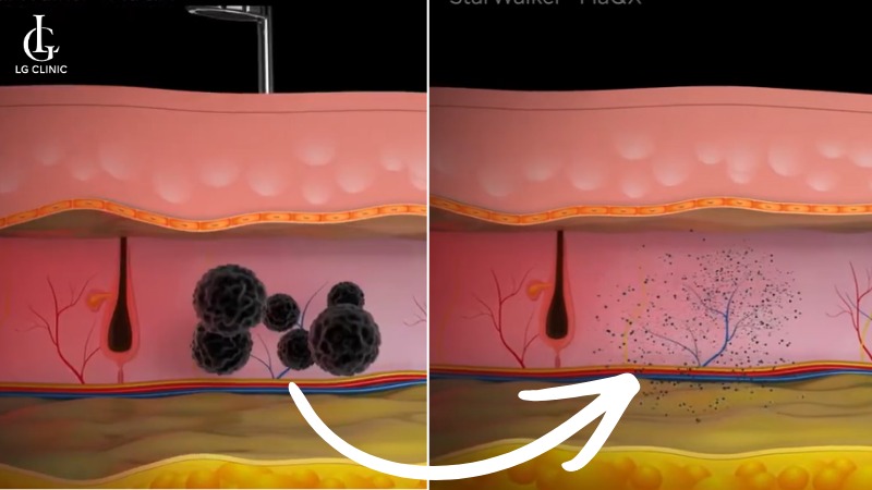 laser fotona trị thâm