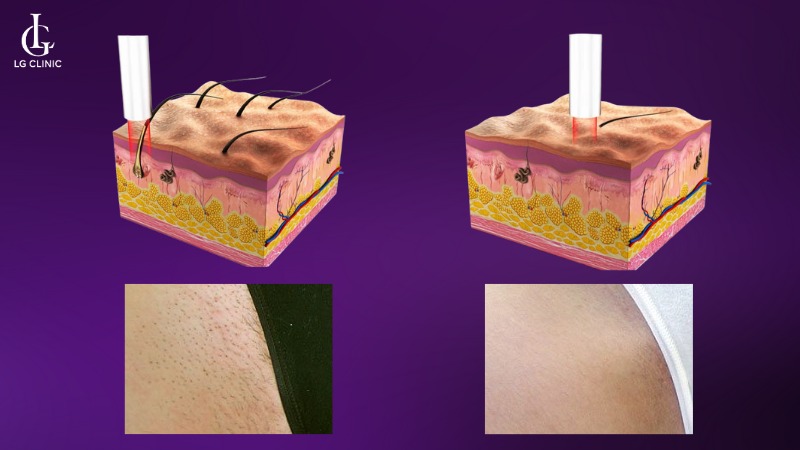 laser fotona triệt lông