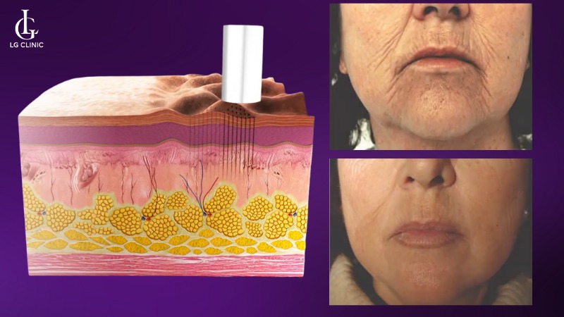 laser fotona xóa nhăn