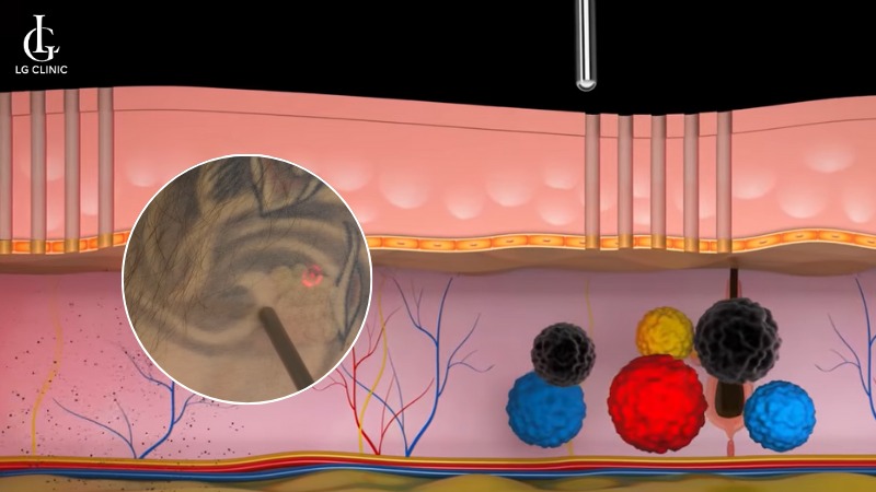laser fotona xóa xăm