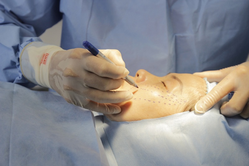 phẩu thuật để nâng cơ mặt