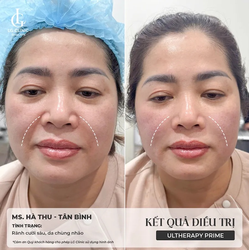 ở nơi có nhiều ca thực tế