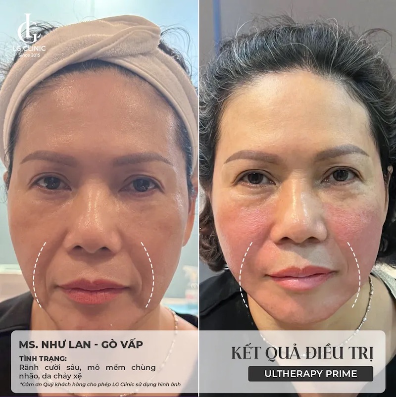 hình ảnh thực tế ultherapy 2