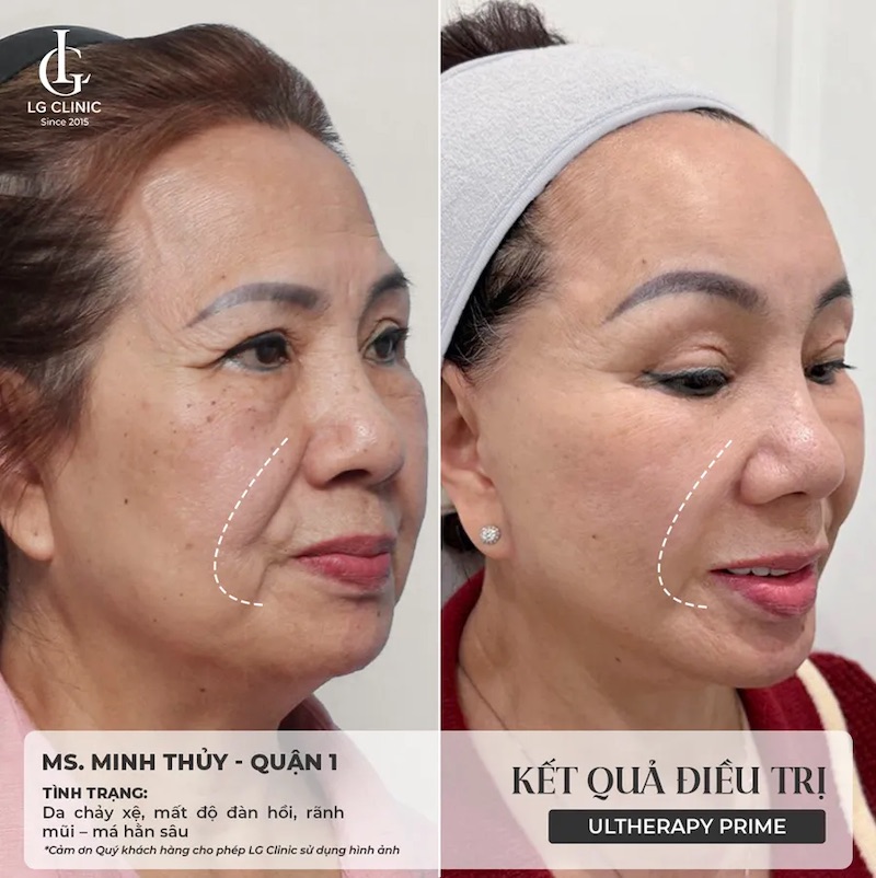 hình ảnh thực tế ultherapy 3