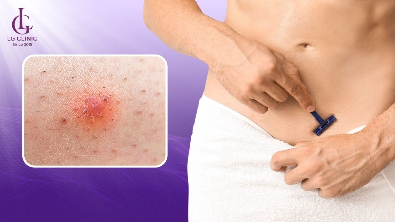 cạo nhổ lông gây ngứa vùng kín