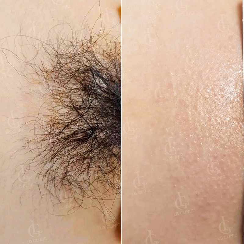 triệt lông giúp giảm ngứa vùng kín