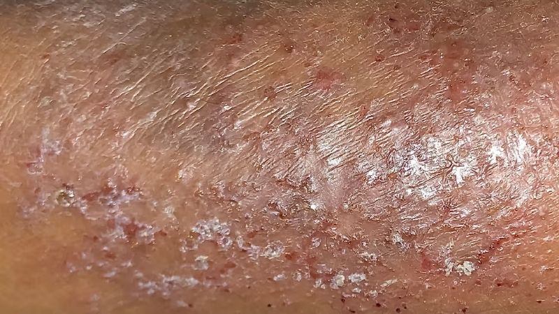 da vùng kín có vảy trắng bị ngứa 