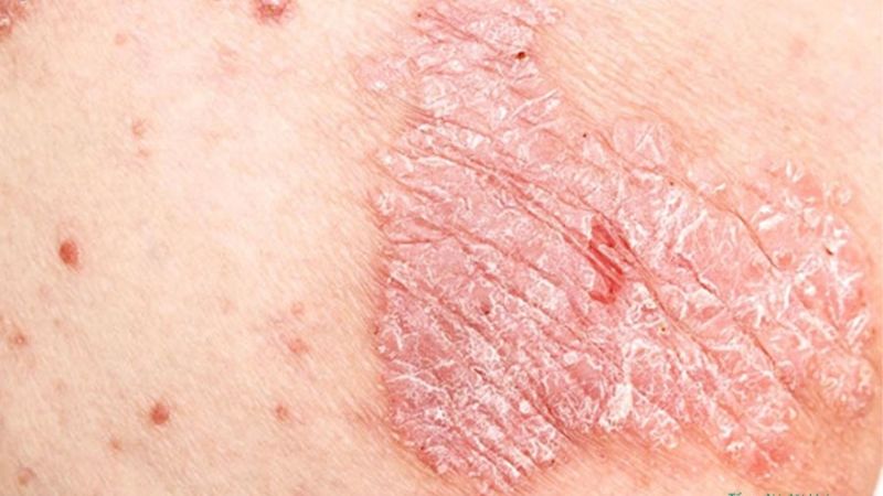 nguyên nhân bệnh lý ngứa vùng kín có vảy trắng