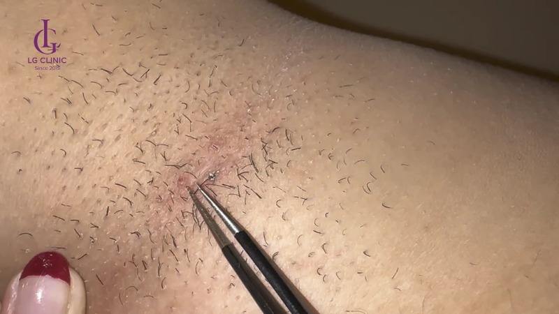 Nhổ lông nách vào ban đêm có sao không