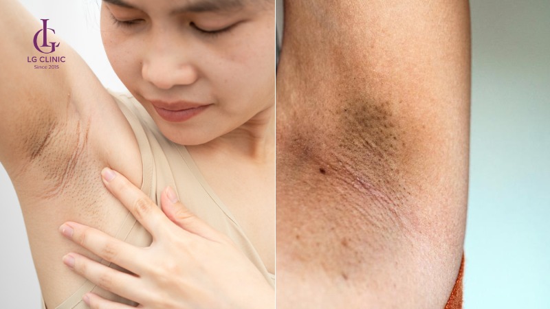 Nhổ lông nách vào ban đêm có sao không