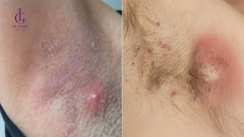 Nhổ lông nách vào ban đêm có sao không