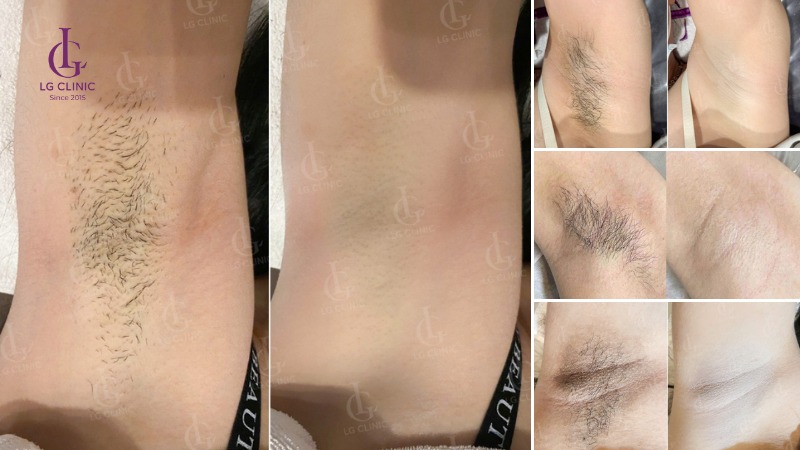 Nhổ lông nách vào ban đêm có sao không