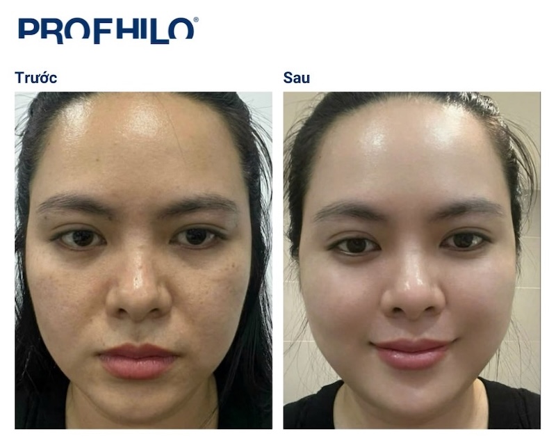 hình kết quả tiêm profhilo structura