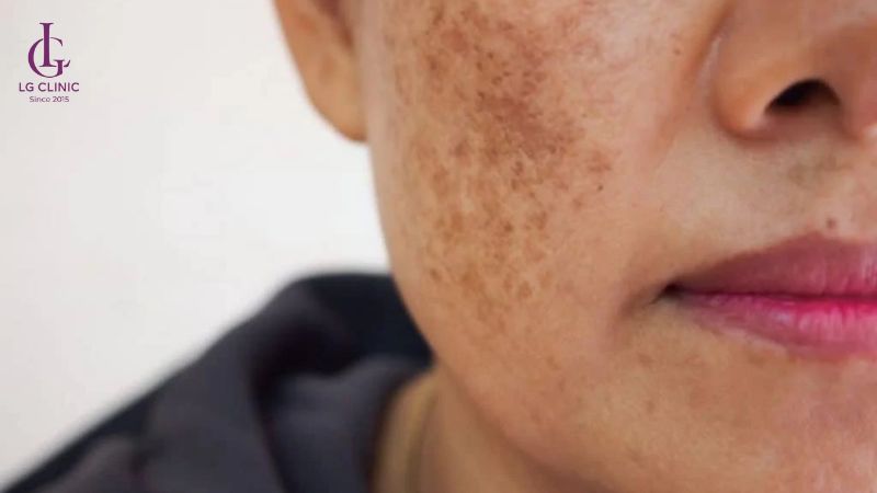 sau bắn laser da bị thâm