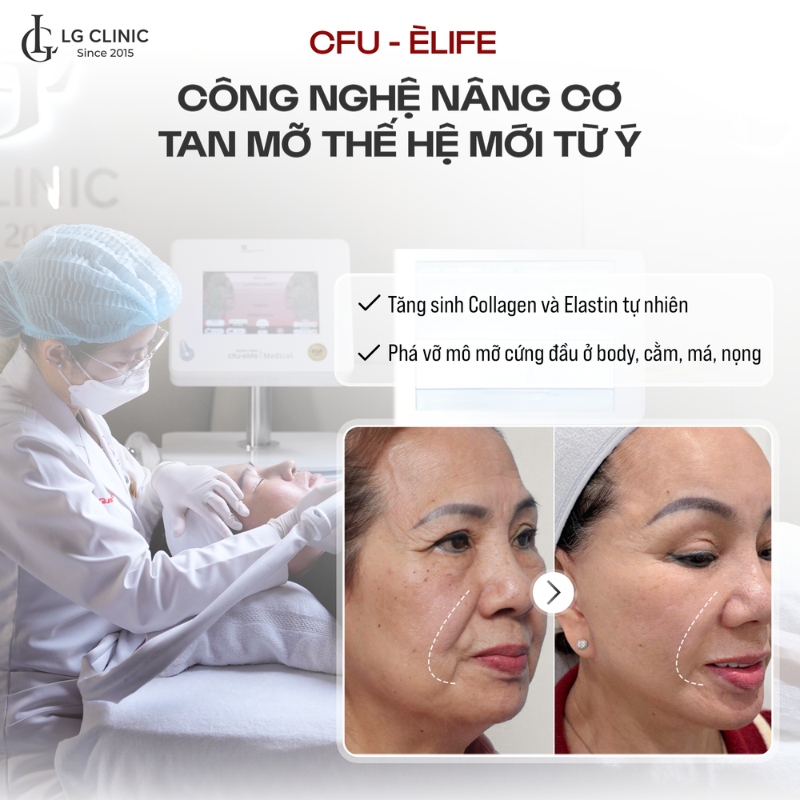 Công nghệ nâng cơ CFU Èlife