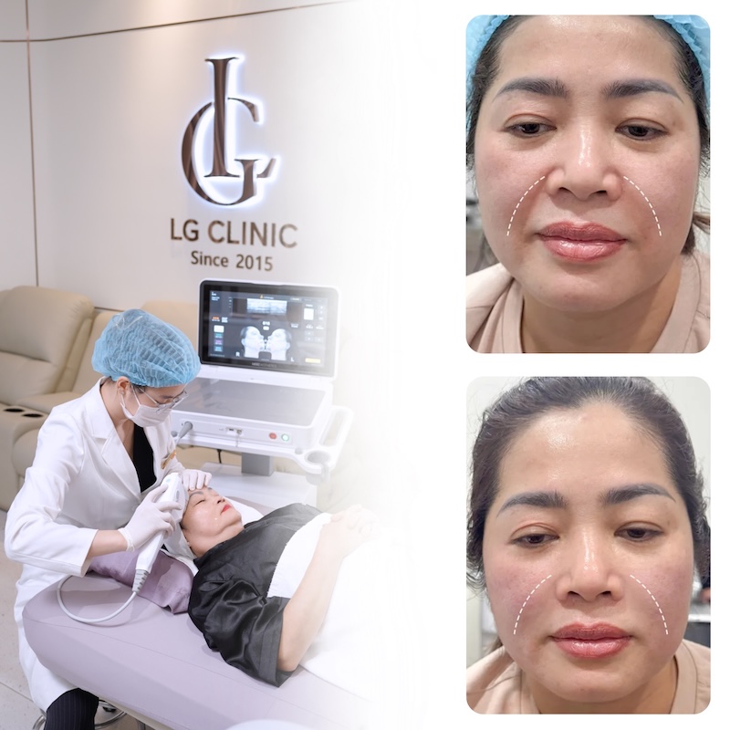 nâng cơ ultherapy prime