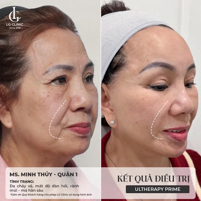 kết quả nâng cơ ultherapy