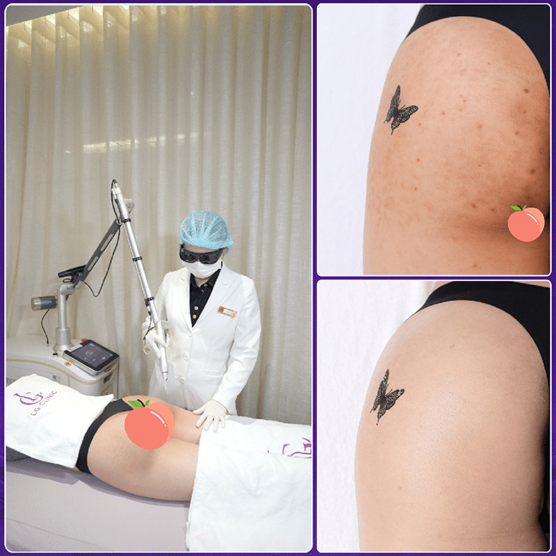 spa trị thâm quận 11