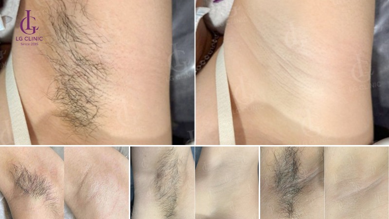 triệt lông nách có tác dụng gì