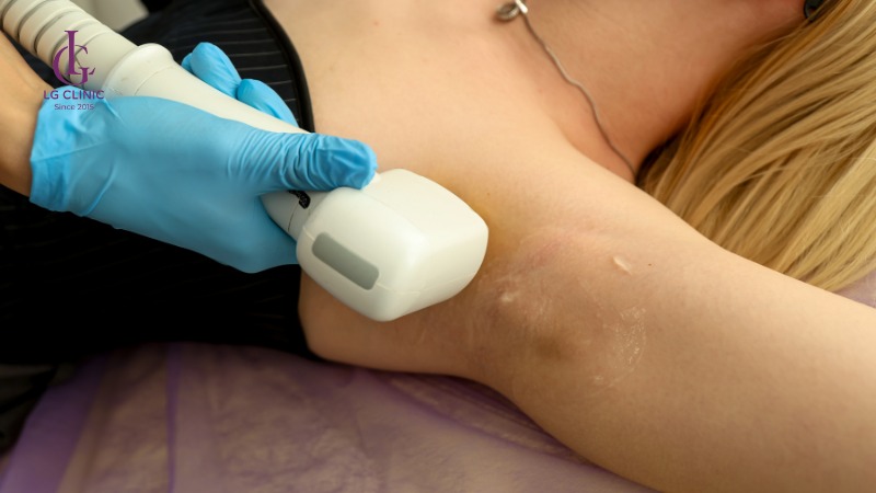 triệt lông nách có tác dụng gì