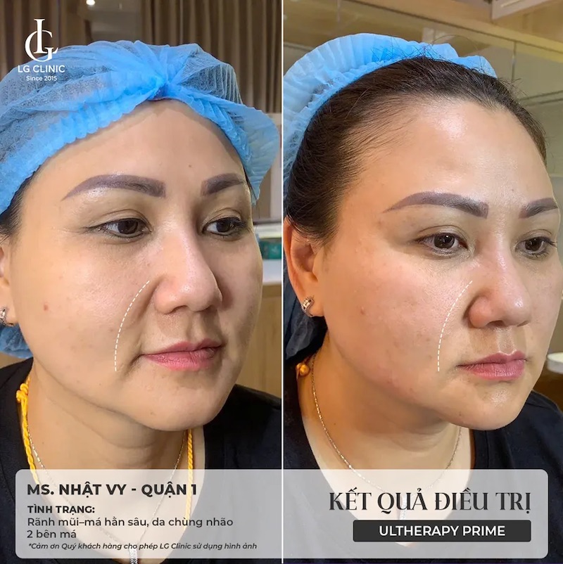 hiệu quả sau khi sử dụng ultherapy prime