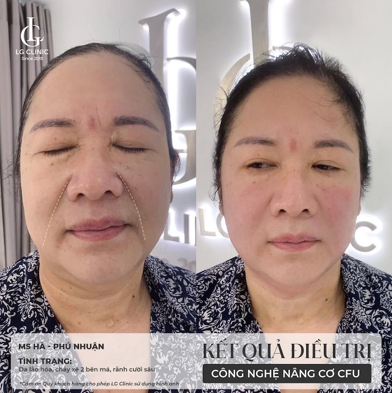 kết quả sử dụng nâng cơ cfu